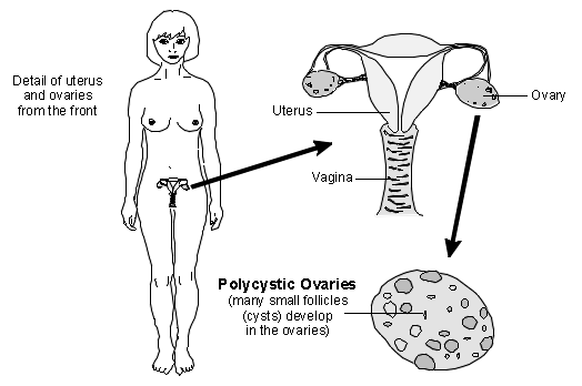 pcos