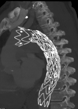 endoprothese bij aortadissectie